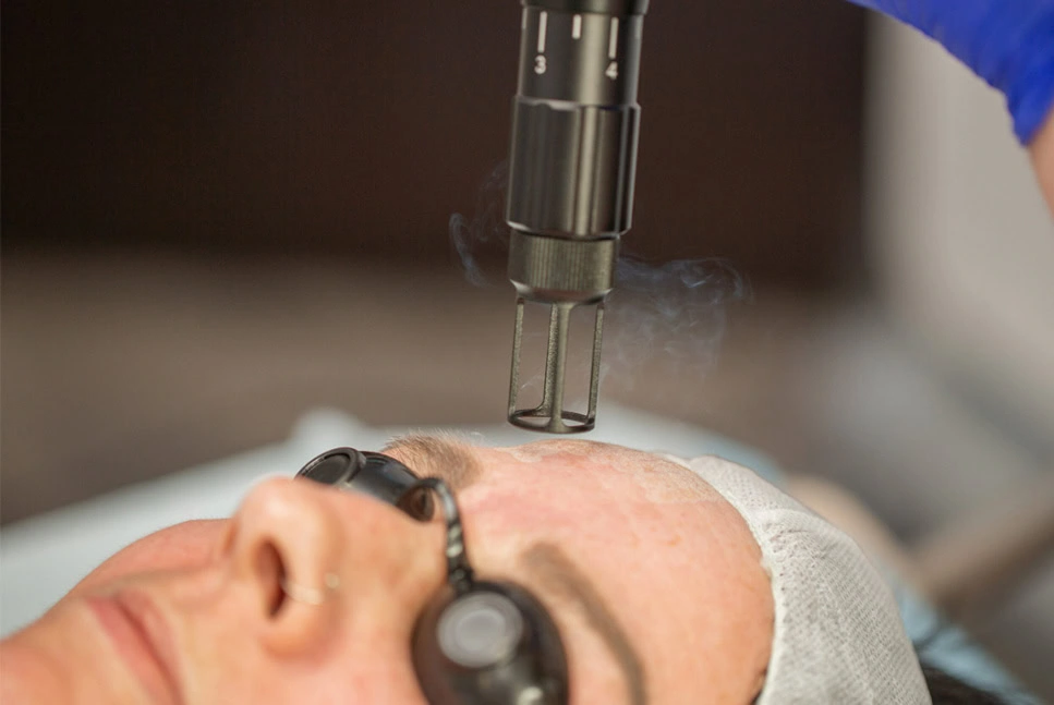 Erbium-YAG-Laser-Resurfacing-services-at-revive-wellness-studio-in-seymour-in