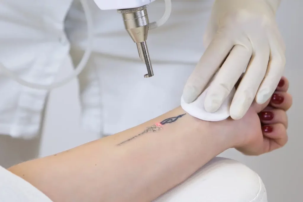 Laser Tattoo Removal in Seymour, IN | Revive Wellness Studio