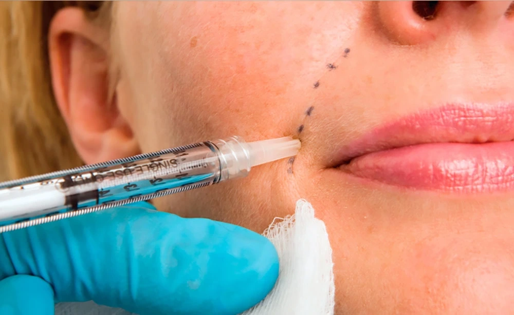 Restylane Dermal Fillers in Seymour, IN |Facial Fillers