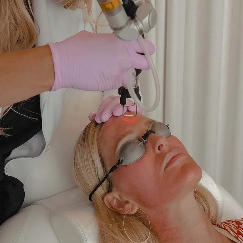 CoolPeel CO2 Laser Skin Treatment in Seymour, IN | Deka Co2